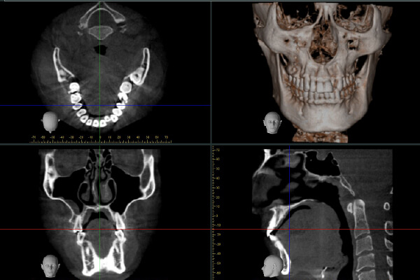 歯科用CT検査