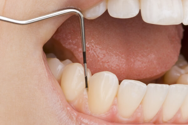歯周精密検査