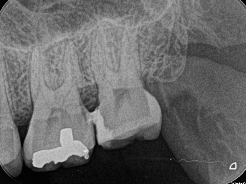 根管治療の症例