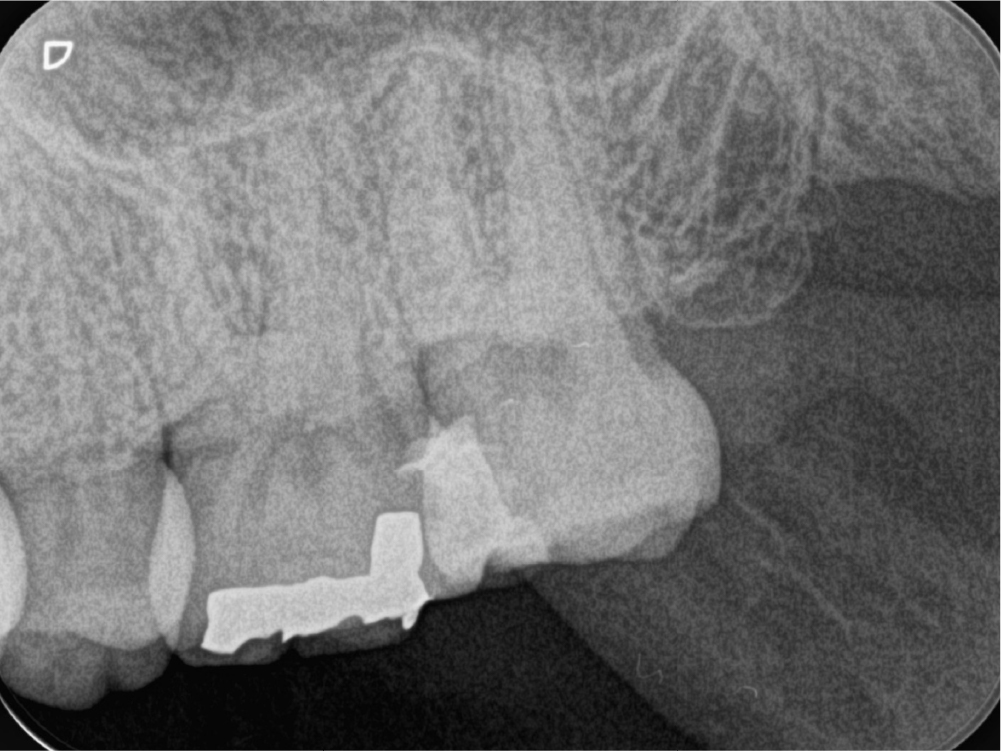 根管治療の症例