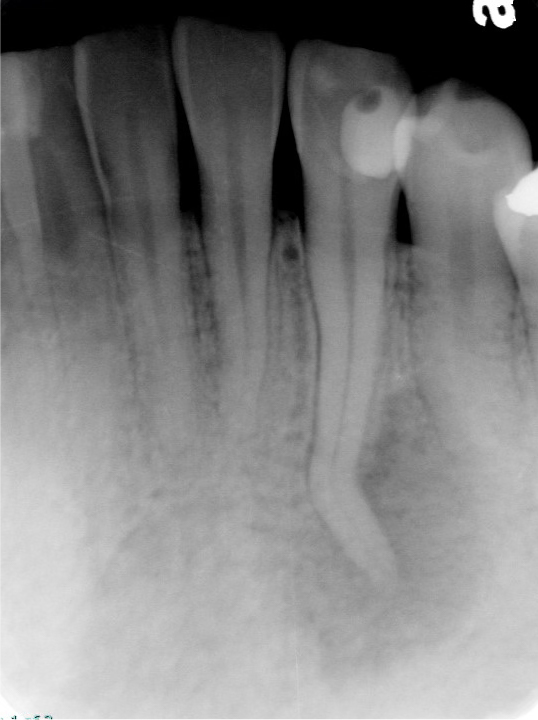 根管治療の症例