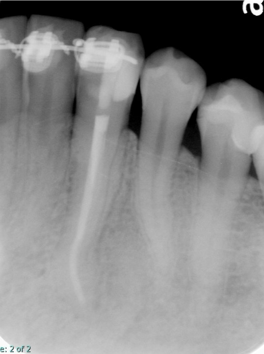 根管治療の症例