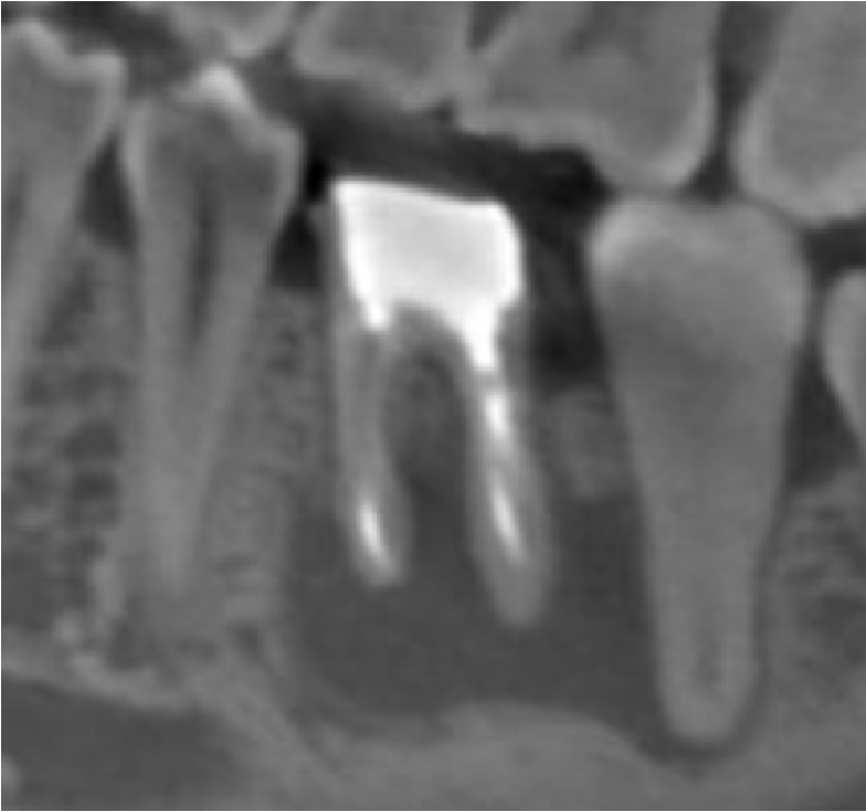 根管治療の症例