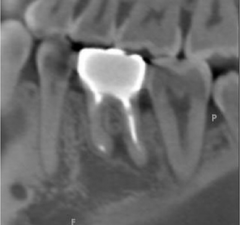 根管治療の症例