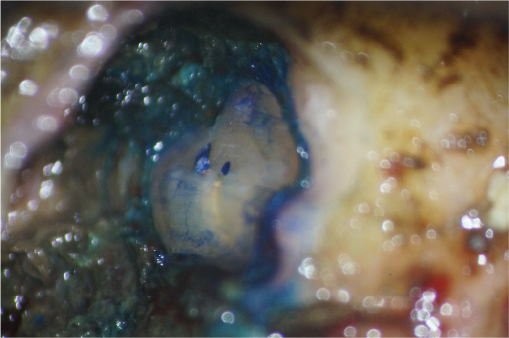 根管治療の症例