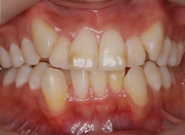 ホワイトニングの症例