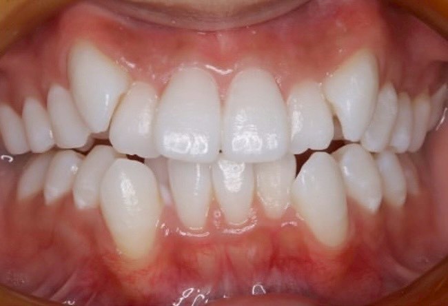 ホワイトニングの症例