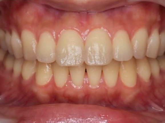 ホワイトニングの症例