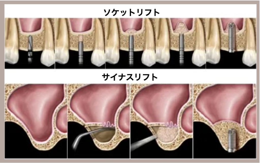 サイナスリフトやソケットリフトの手順やメリット・デメリット、費用について解説いたします。 -  奈良でインプラント専門口腔外科医による治療なら「LOHASデンタルクリニック」