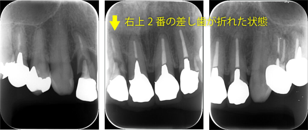術前のレントゲン写真