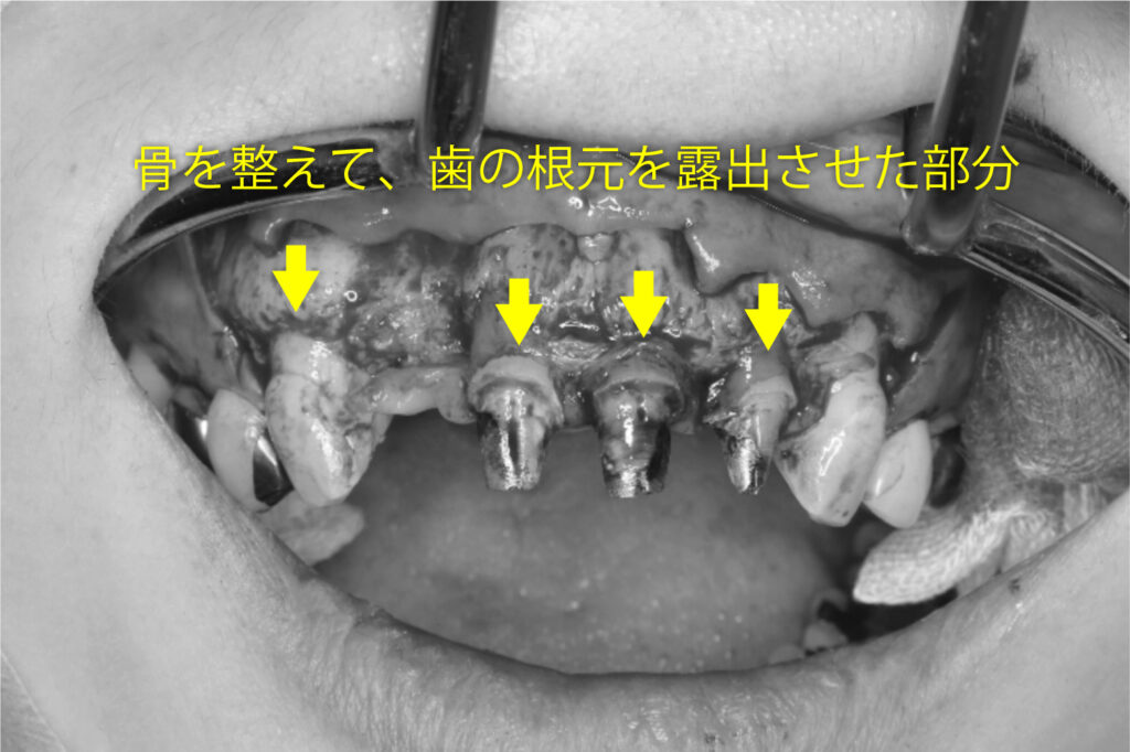 ▲歯冠長延長術の手術中:矢印の部分が、骨を整えて露出させた歯の根元