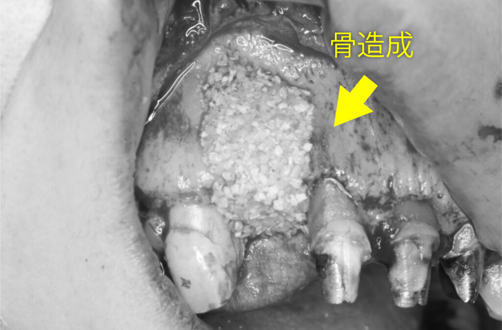 ▲骨造成:インプラントの頬側に骨を補った状態