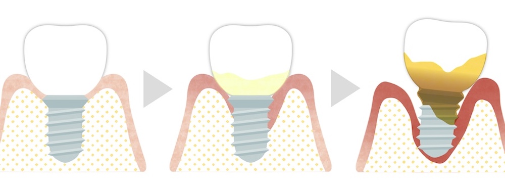 ⑧インプラント周囲炎（インプラントの歯周病）