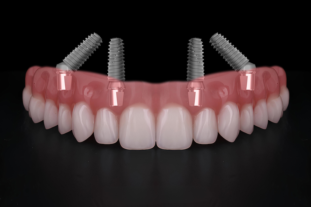 オールオン4で後悔しないために｜失敗例と対策、歯科医院の選び方【歯科医師が解説】