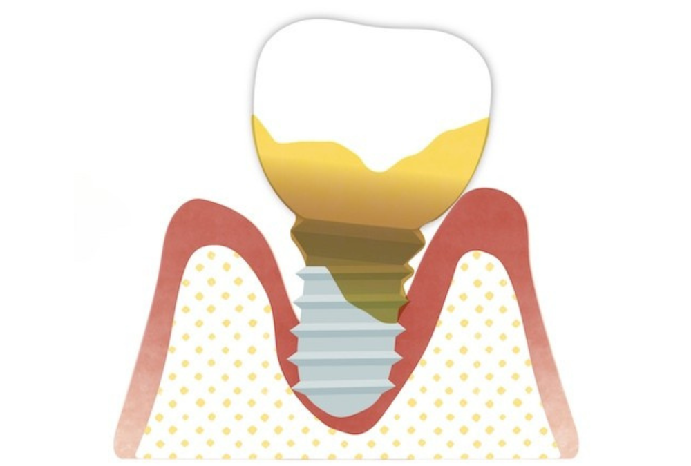 ⑨インプラント周囲炎になってしまった