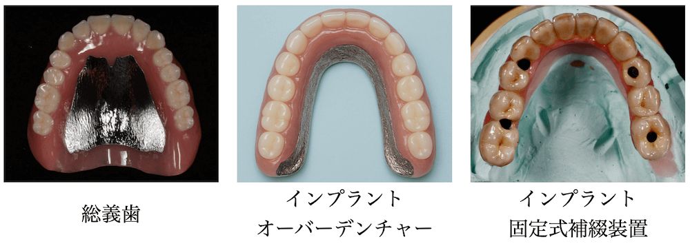 下記に示す図が総義歯とインプラントオーバーデンチャー、固定式のインプラントの場合の補綴物の比較になります。