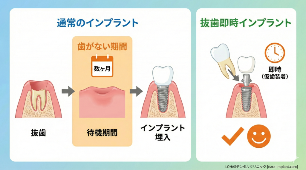 治療法別の前歯インプラントで歯がない期間の目安