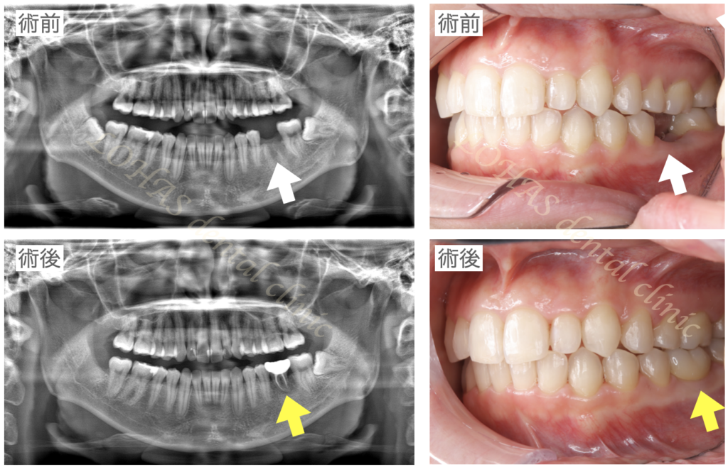 歯が折れて抜歯になった部位に、埋まっている親知らずを自家歯牙移植することでインプラント治療を免れることができた症例