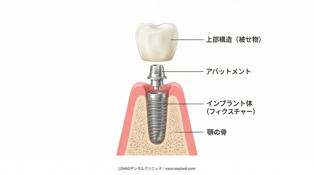 奥歯2本のインプラント費用の細かな内訳