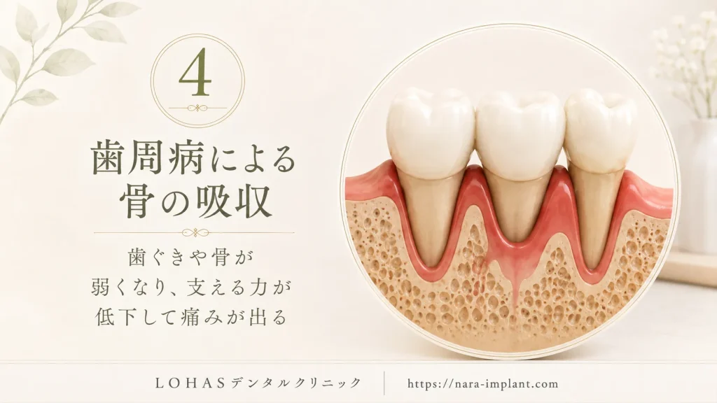原因④:歯周病が進行し、支台歯の周囲の骨が溶けている