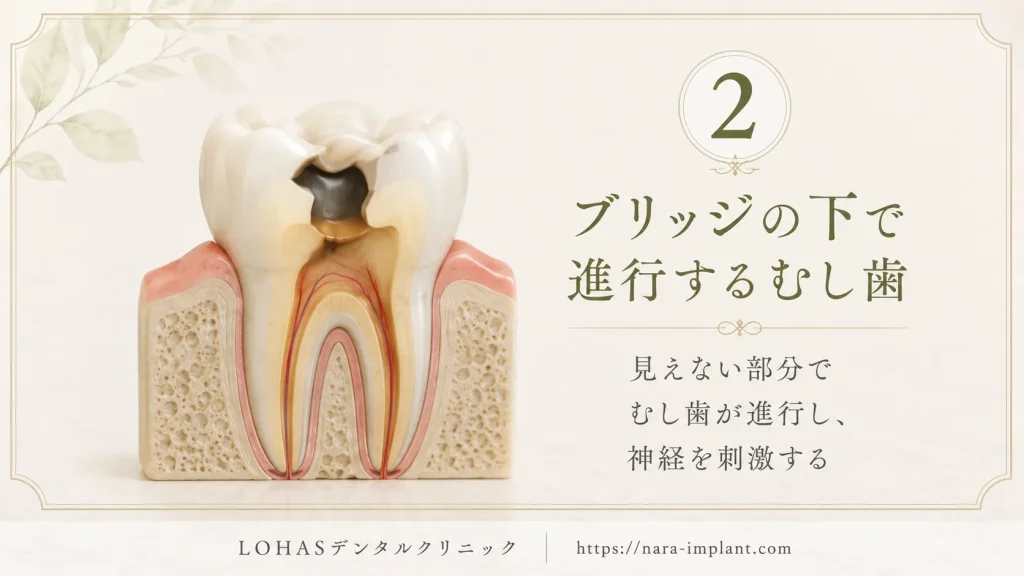 原因②:ブリッジの下で虫歯が進行し、神経が炎症を起こしている