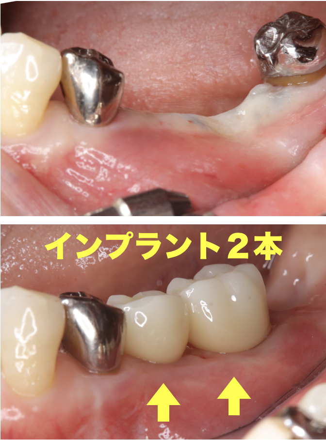 口腔内写真