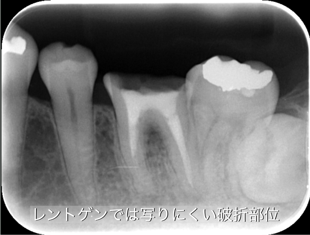 image_tooltip レントゲンで映りにくい破折部分