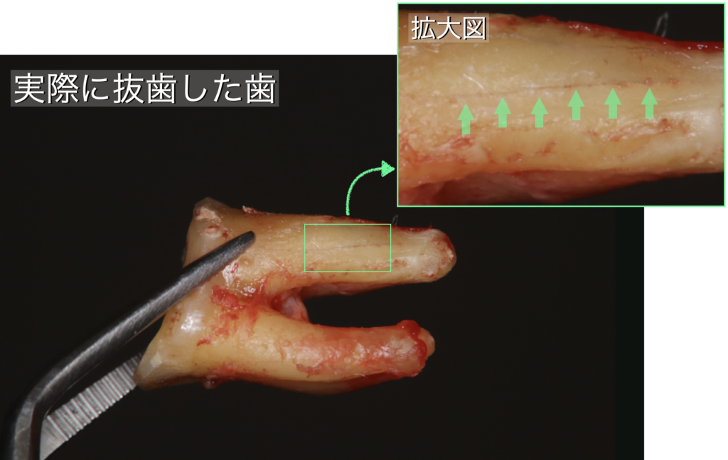 実際に抜歯した歯