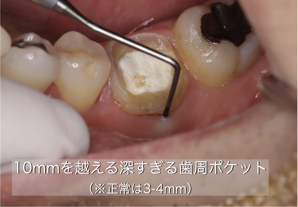 image_tooltip 10㎜を超える深すぎる歯周ポケット