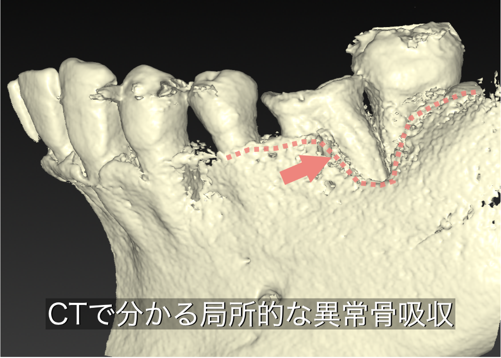 image_tooltip CTでわかる局所的な異常骨吸収