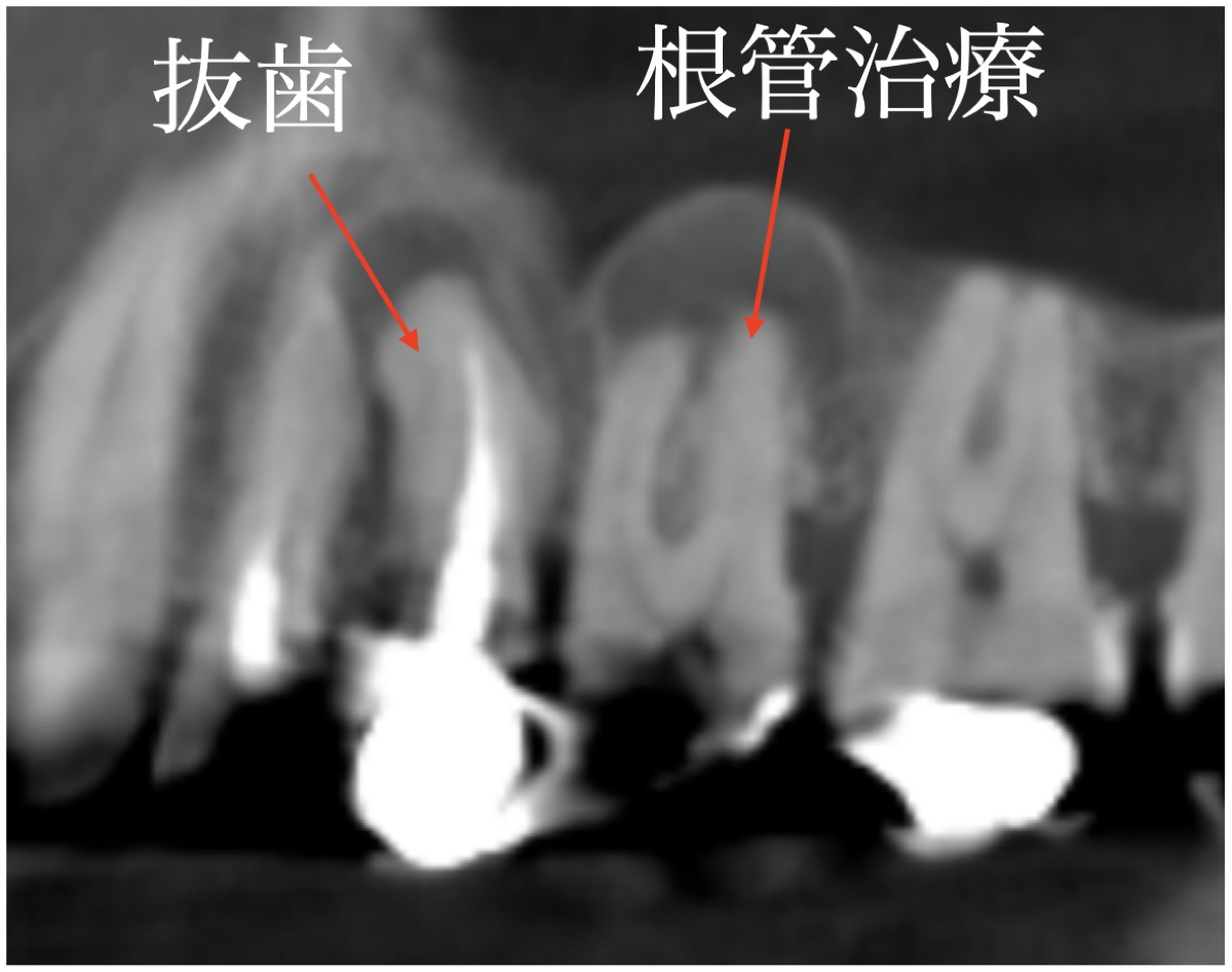 初診時のCT。抜歯する歯と根管治療を行う歯を矢印で示している