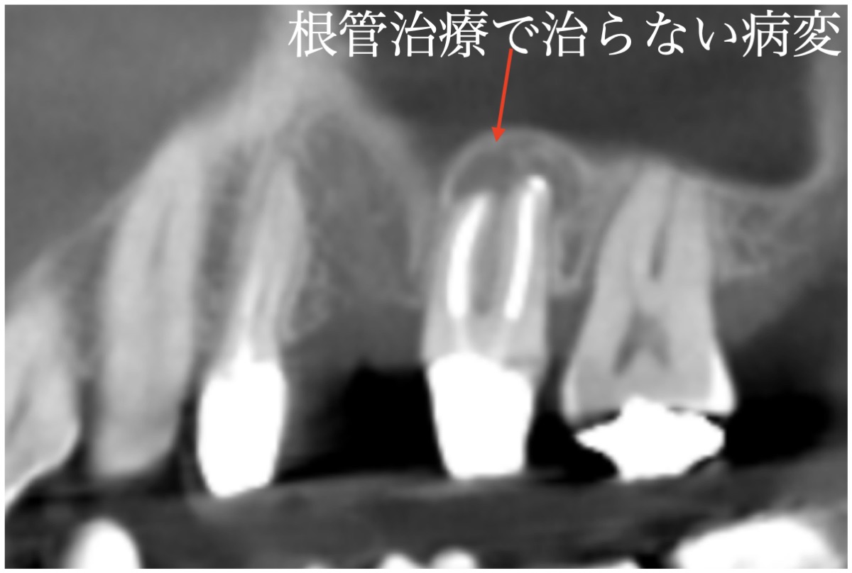 根管治療後のCT。根の先に病変が残っている